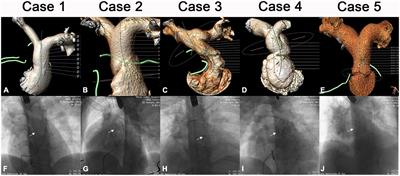 First hybrid implantations of novel Salus-Valves in patients with severe pulmonary regurgitation: A case series